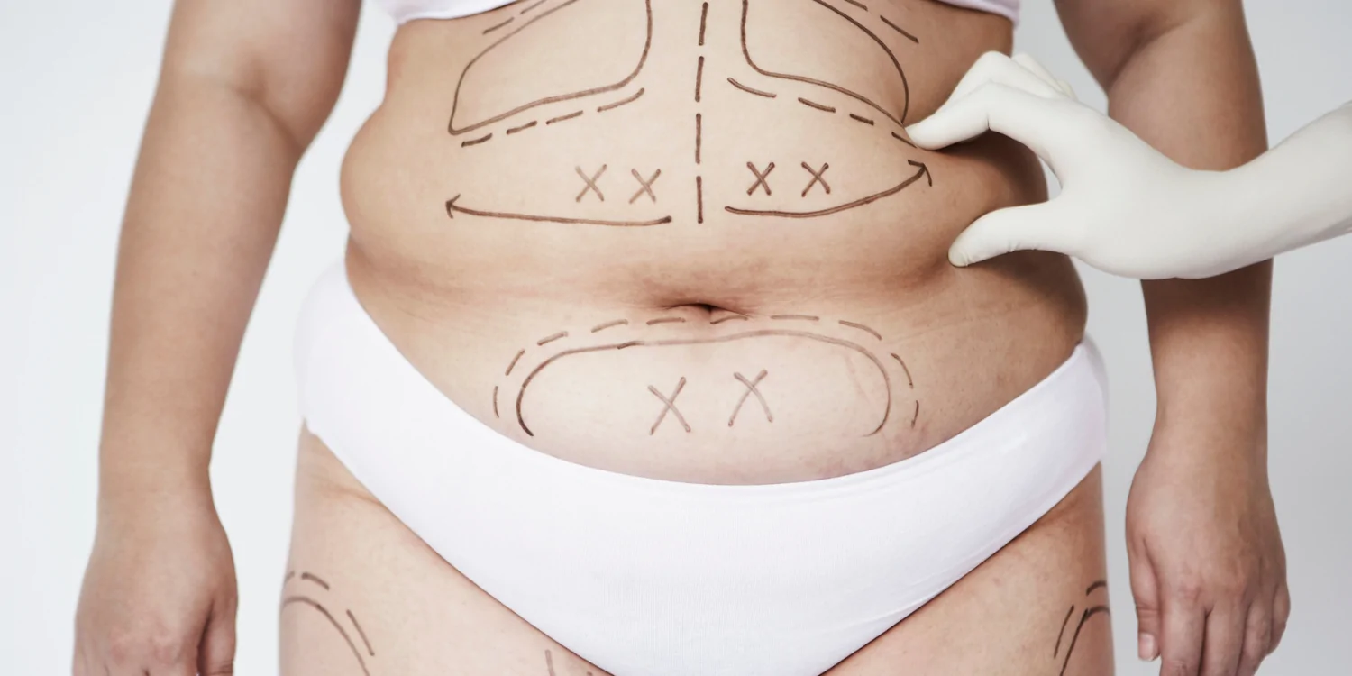 Liposuction Explained: Who Is the Right Candidate?