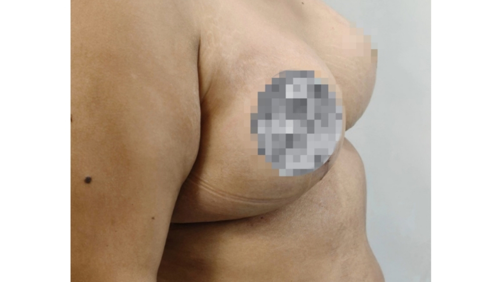 After surgery