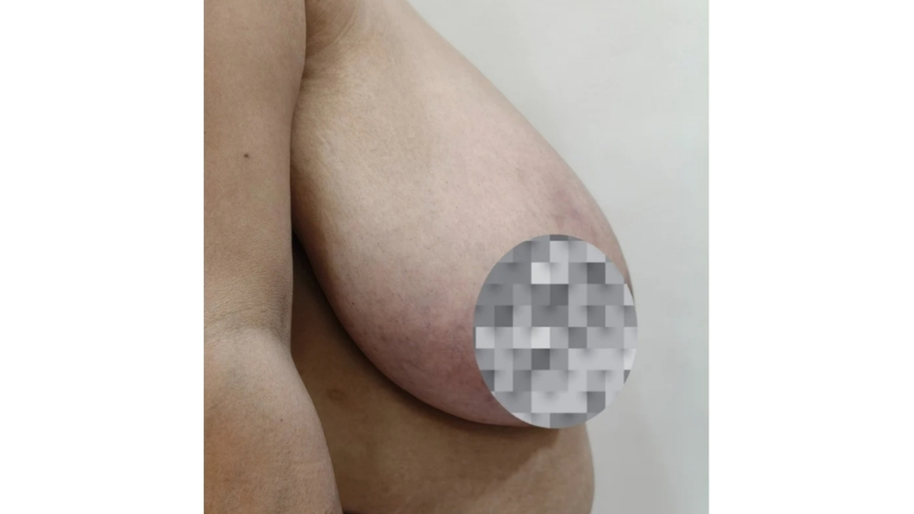 Before surgery