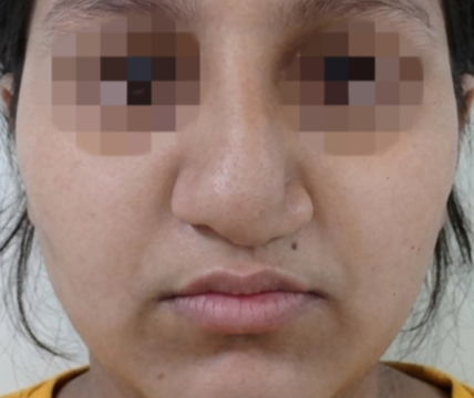 After surgery