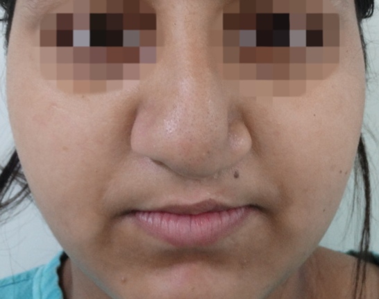 Before surgery