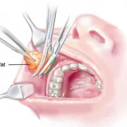 Buccal Fat Removal — procedure visual