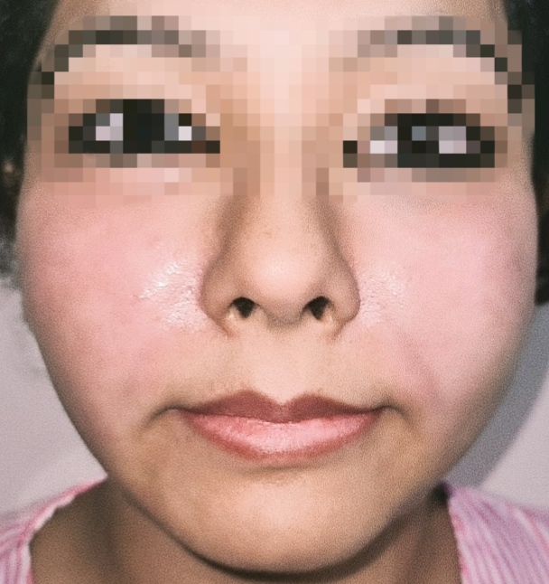 After surgery