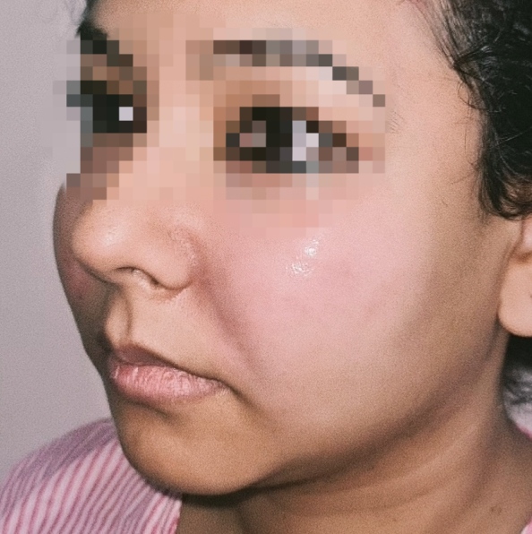 After surgery