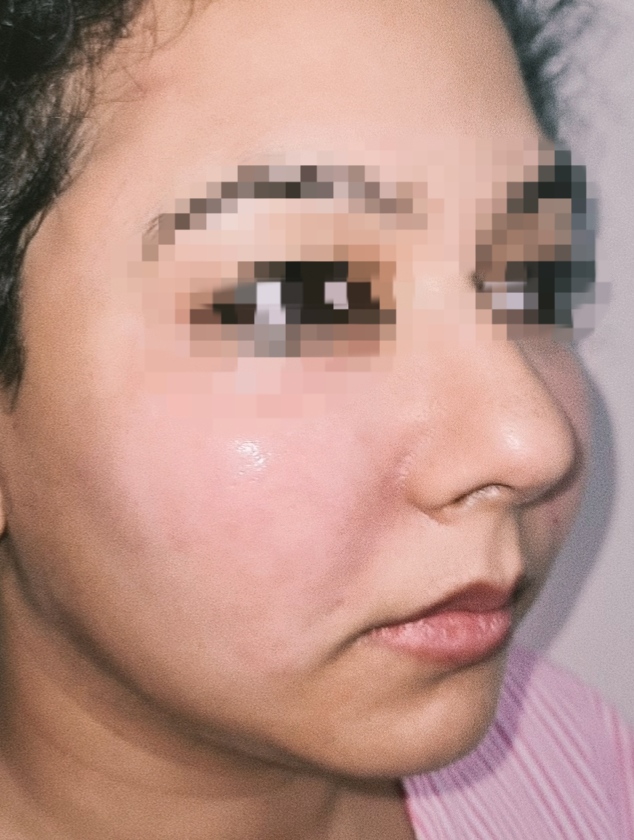 After surgery