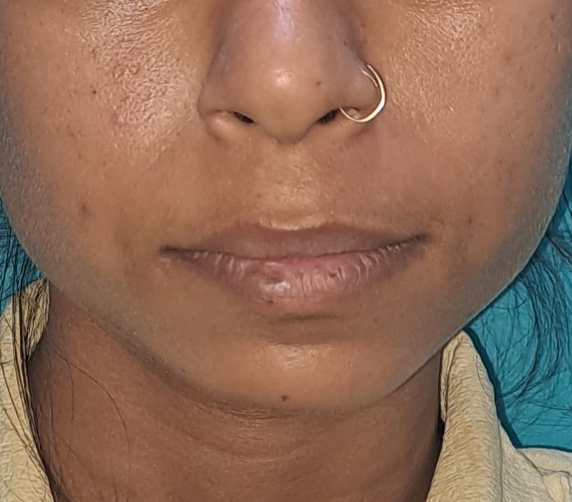 Before surgery