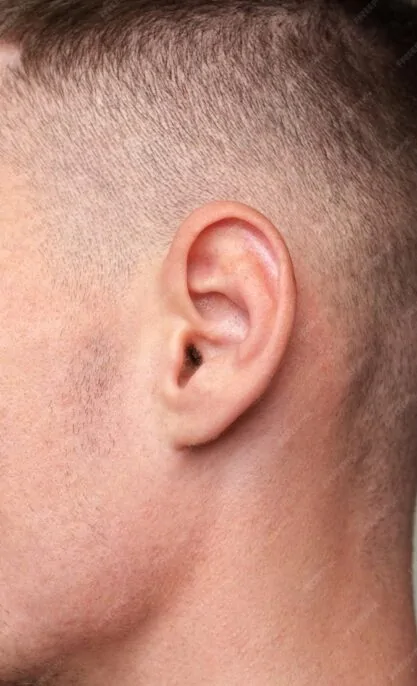 Ear Correction Surgery — procedure visual