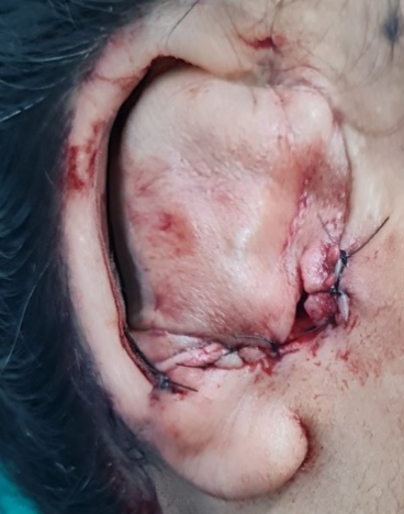After surgery