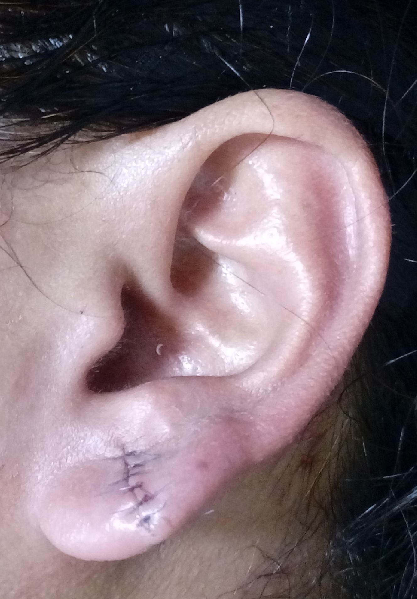 After surgery