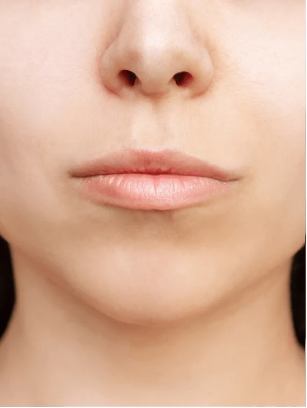 Lip Augmentation — patient outcome