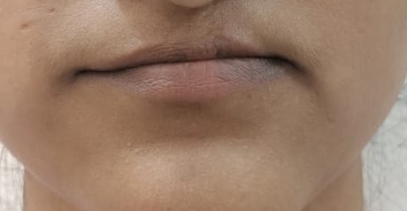 Before surgery