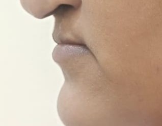 Before surgery