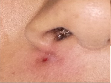 After surgery