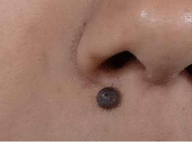 Before surgery