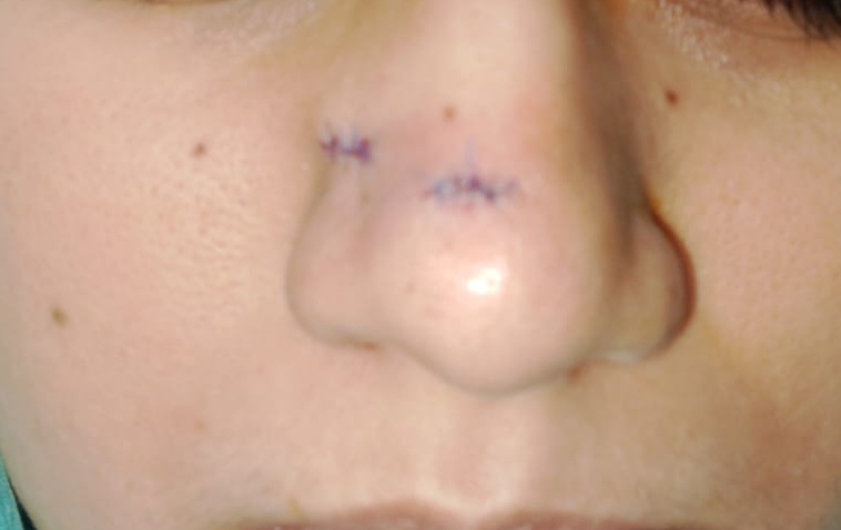 After surgery
