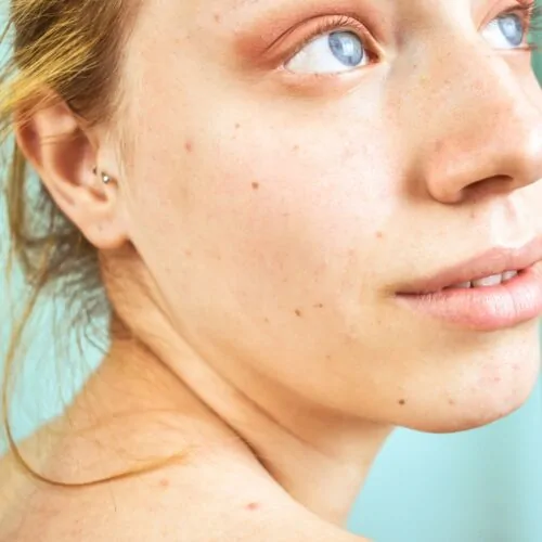 Mole Excision — procedure visual