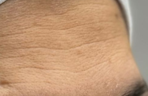 Before surgery