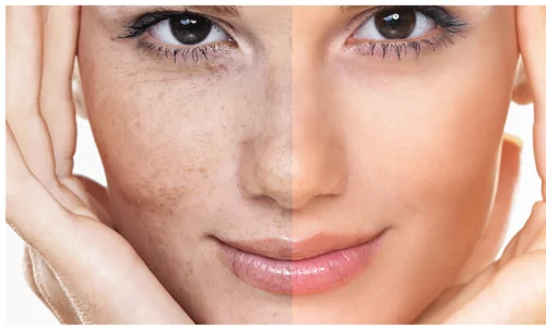 Dermal Fillers