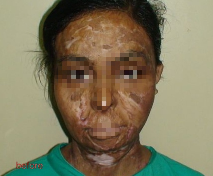 Before surgery