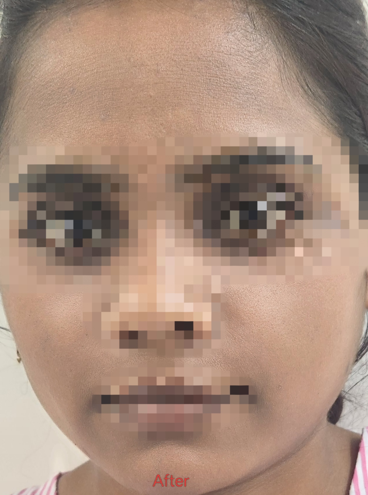 After surgery