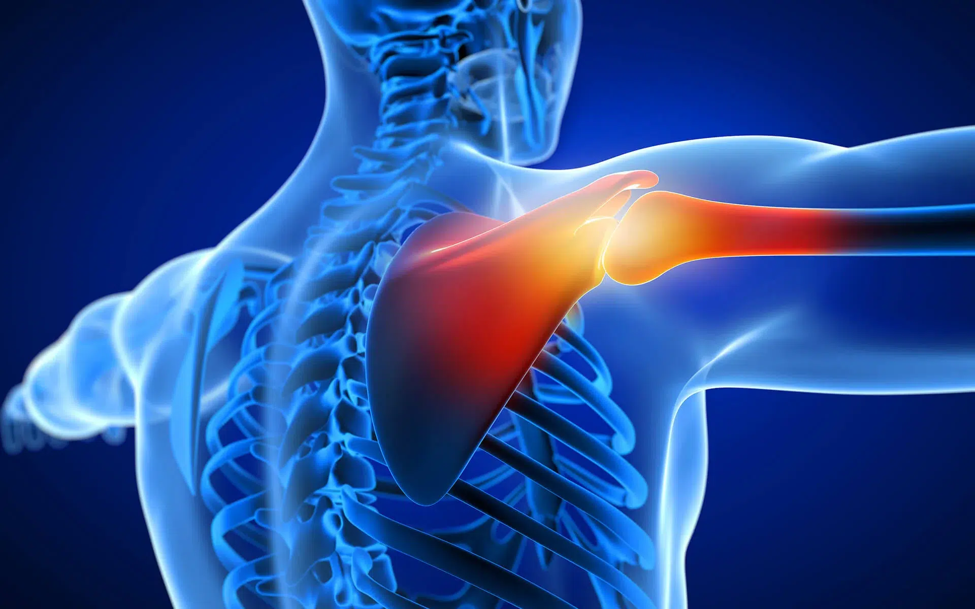 Complete Brachial Plexus Injury — hero image