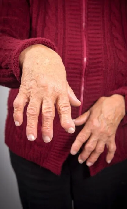 Cerebral Palsy Hand Deformity