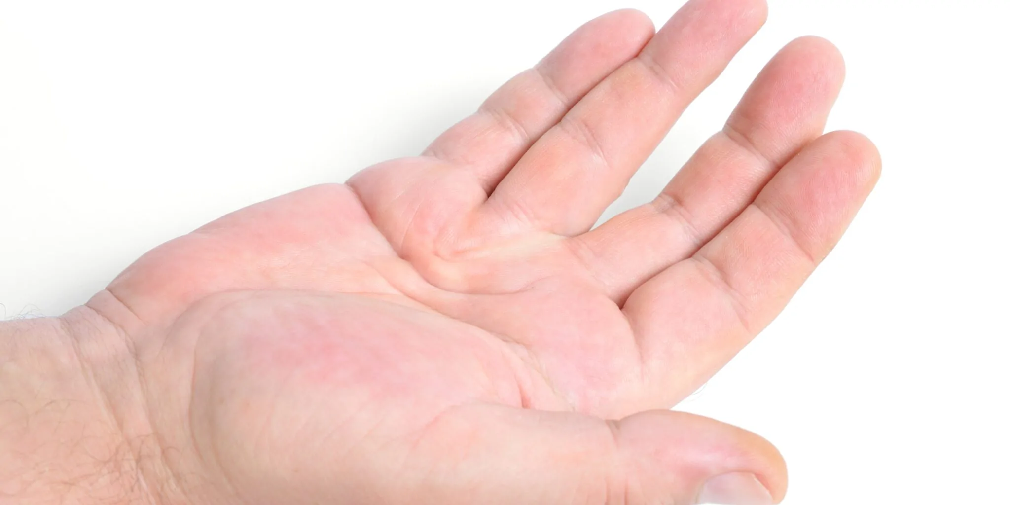 Dupuytren's Contracture — hero image