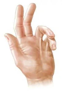 Dupuytren's Contracture