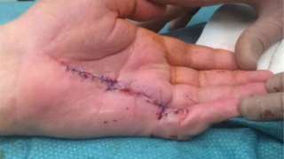After surgery