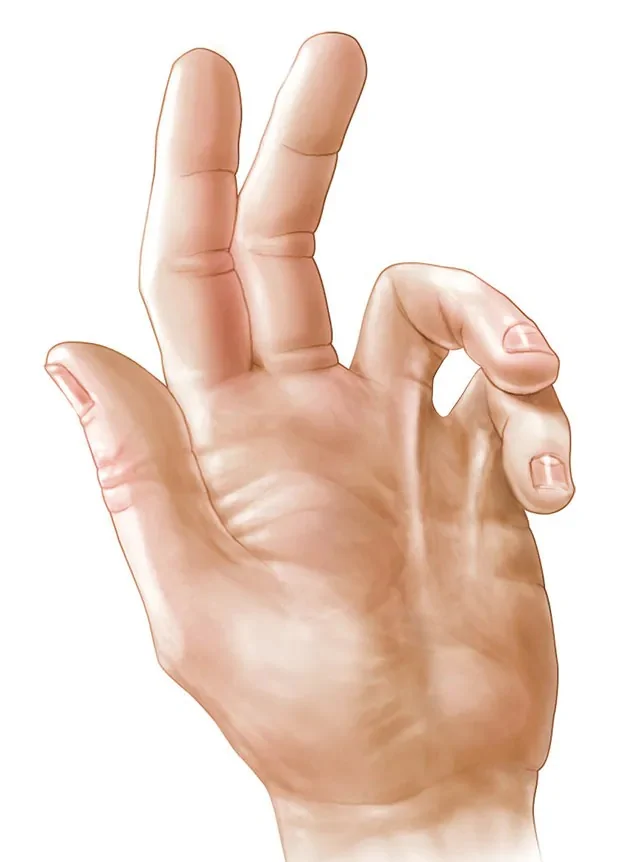 Dupuytren's Contracture