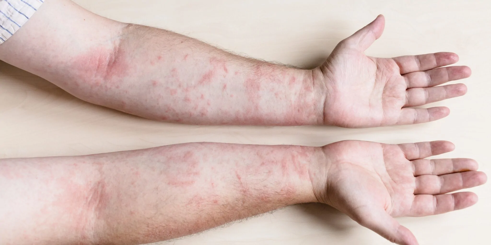 Hand Infections — hero image