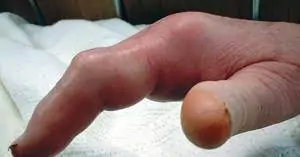 Hand Infections