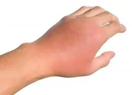Hand Infections