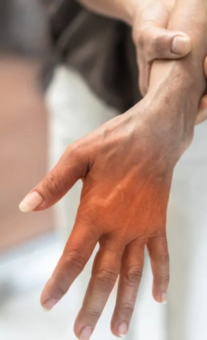 Stiff Hand