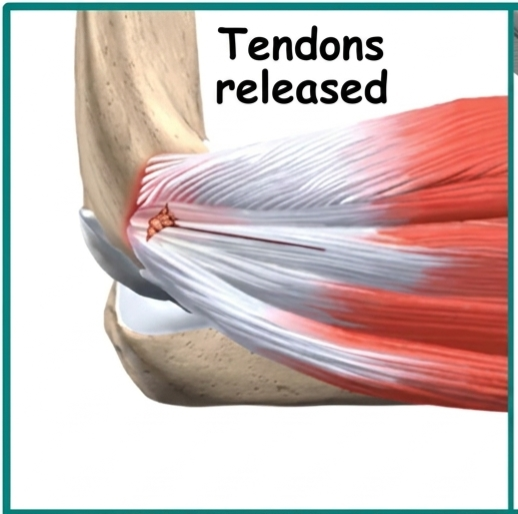 Understanding Tennis Elbow