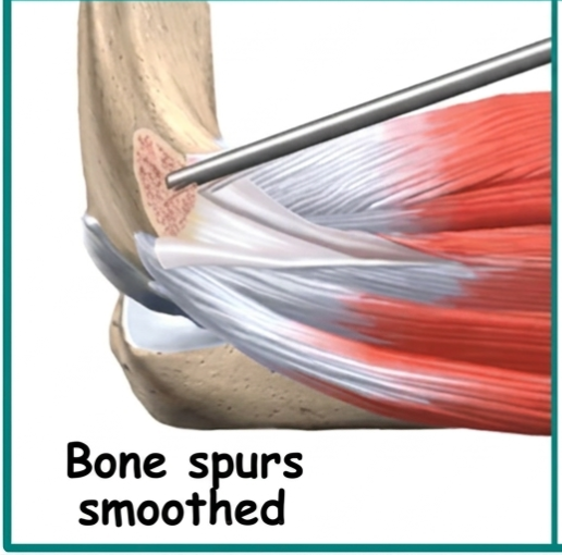 Understanding Tennis Elbow