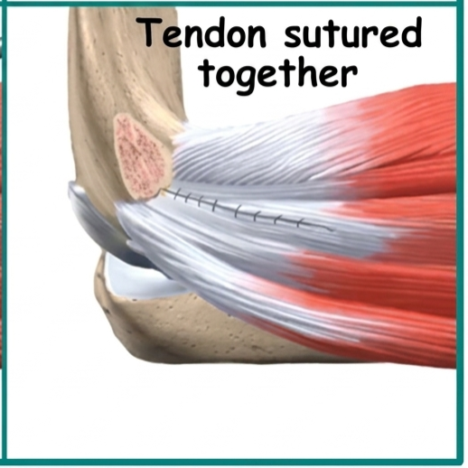 Understanding Tennis Elbow