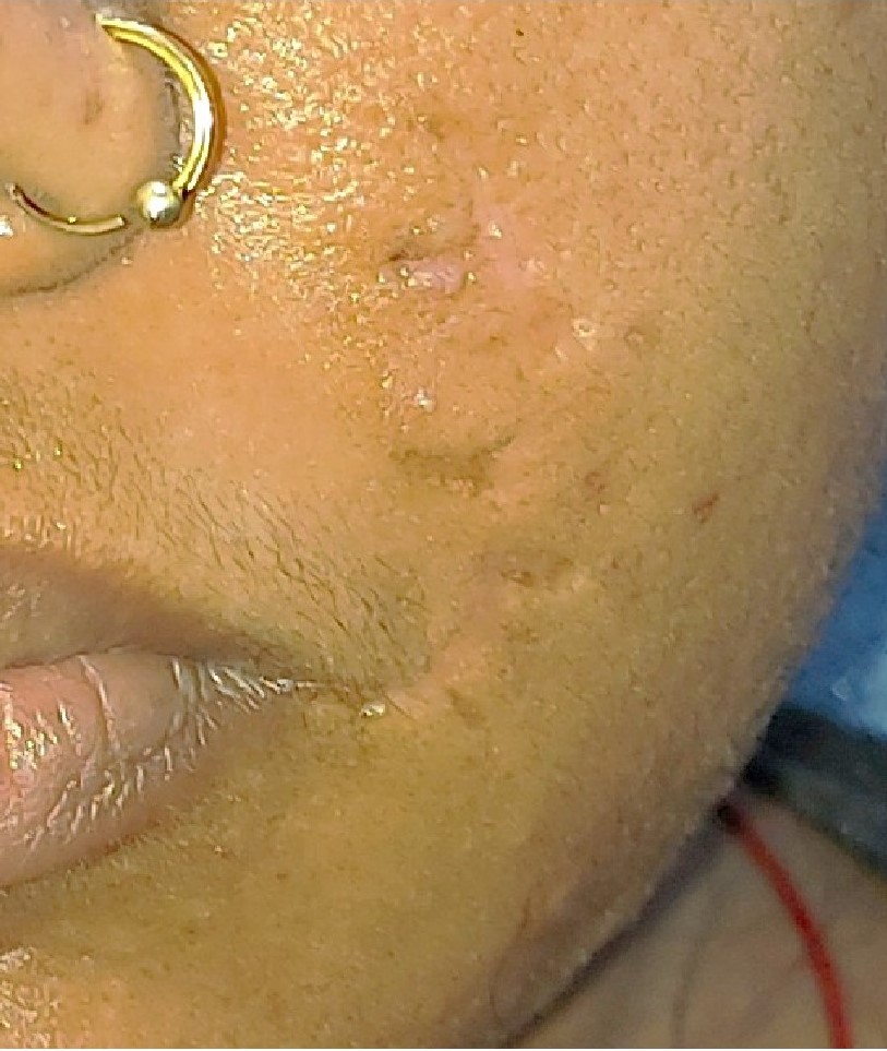 After surgery