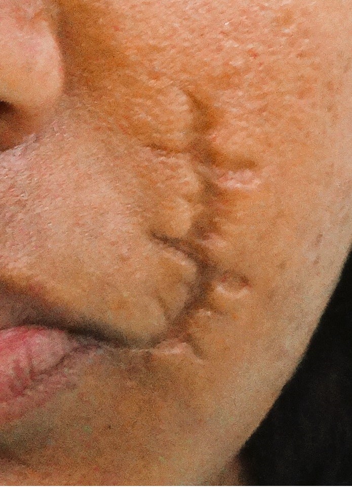 Before surgery