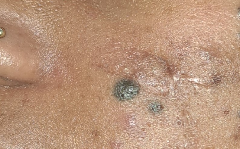 After surgery
