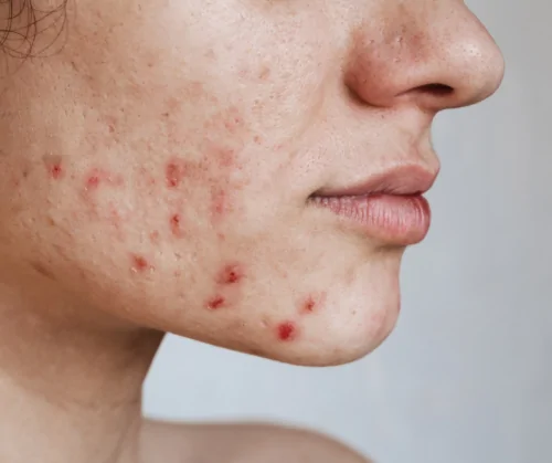 Scar Revision — procedure visual